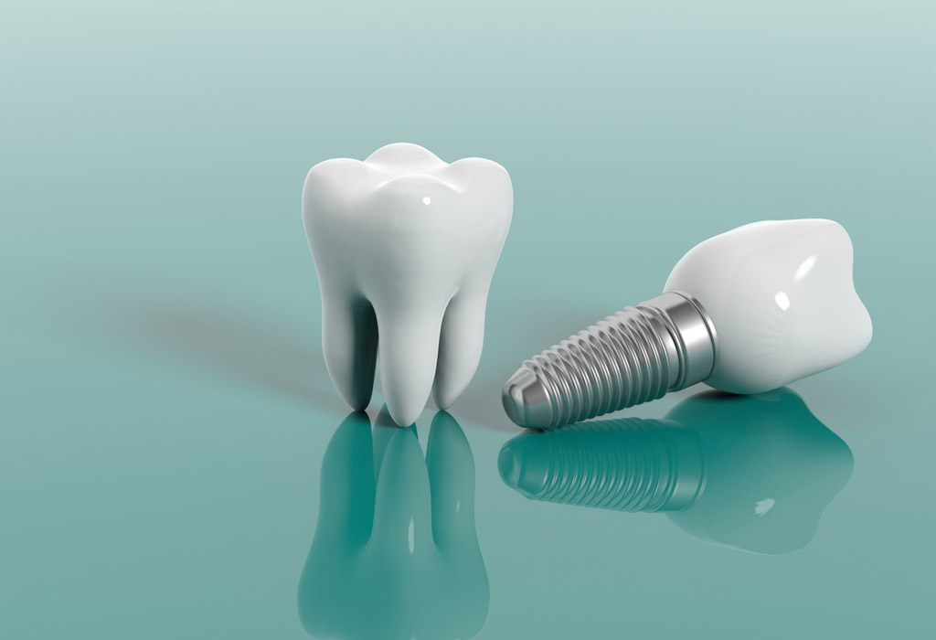 materiales de implantes